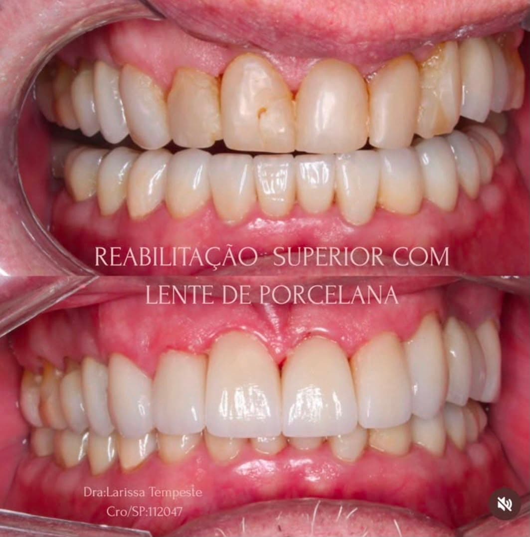 Reabilitação superior com lente de porcelana