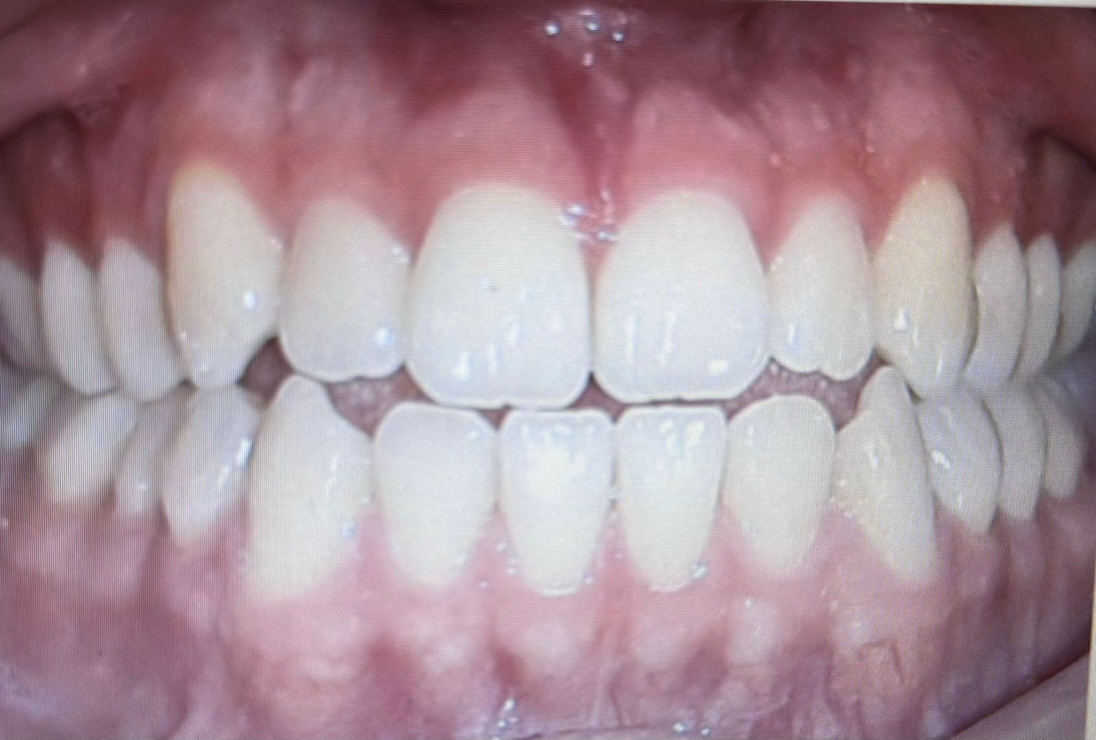 Antes