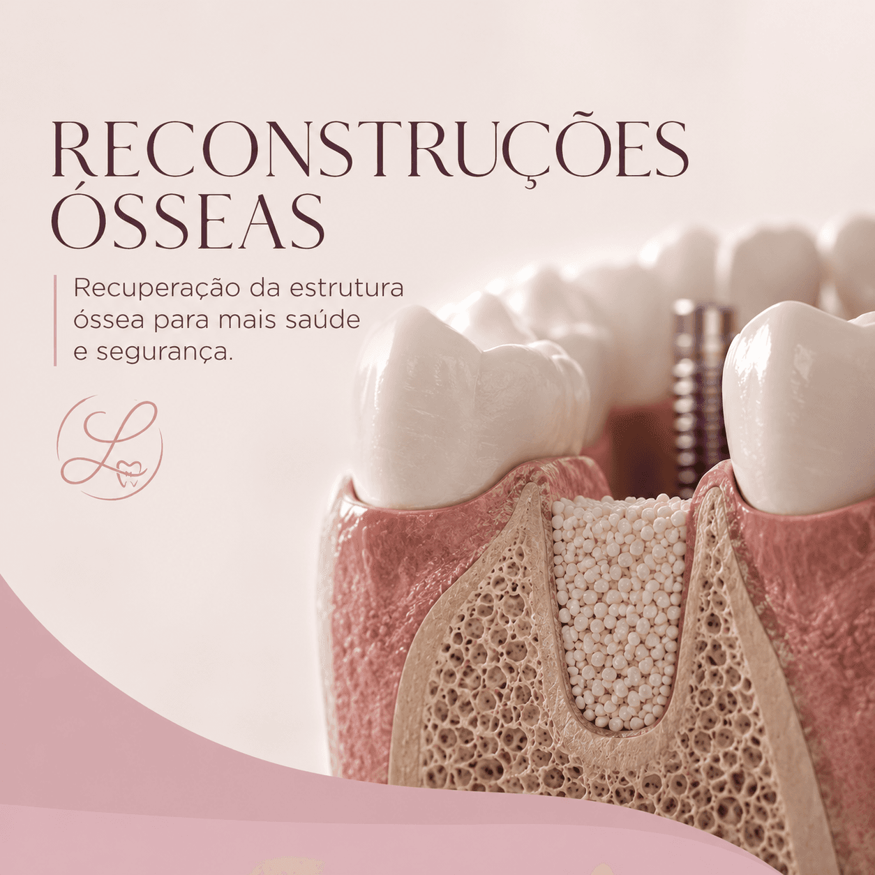 Reconstruções Ósseas
